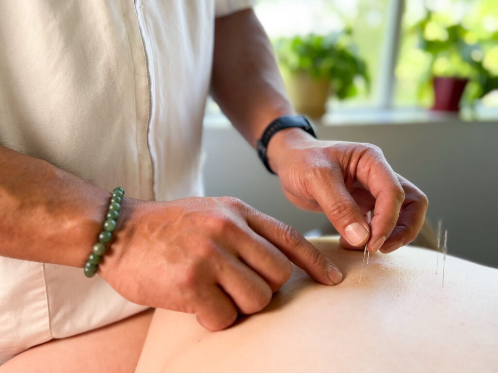 Acupuncture treatment at Santa Cruz Acupuncture Orthopedics & Sports Medicine Clinic