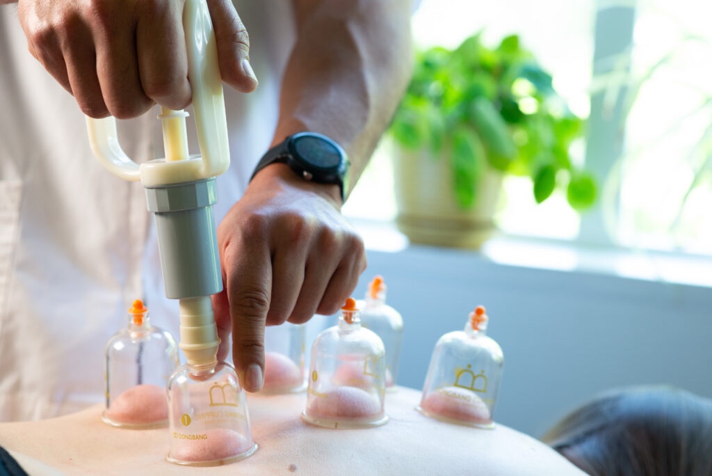 Cupping therapy